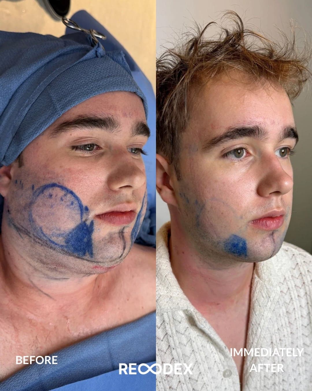 Male Facial Sculpting — before and after