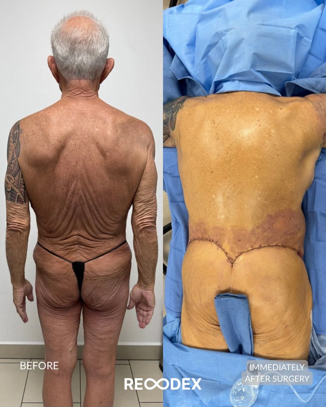 MAXORIS Body Sculpting — before and after