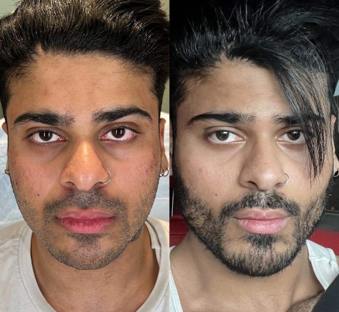 Male Facial Sculpting — before and after