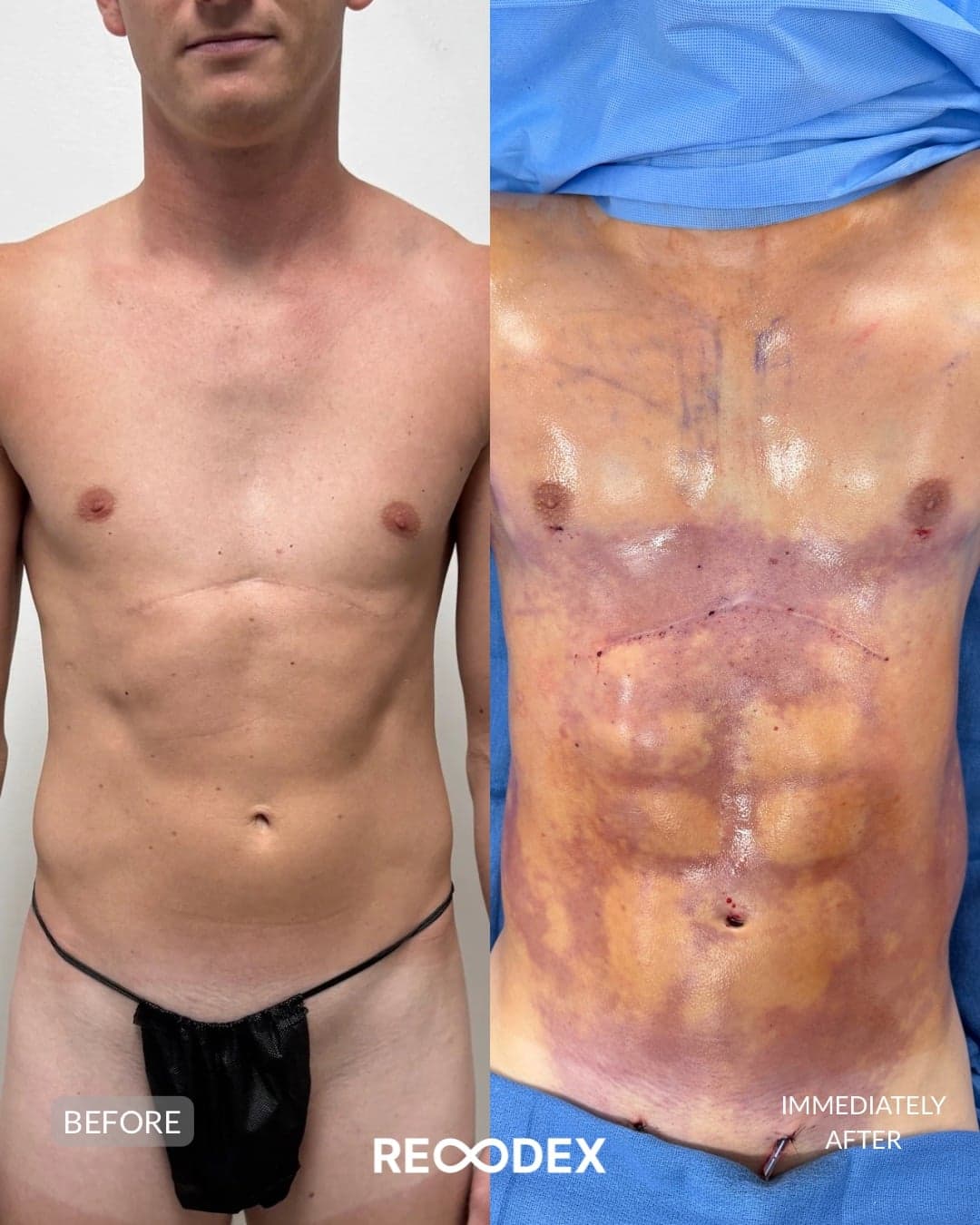 HD Body Sculpting & Implants — before and after