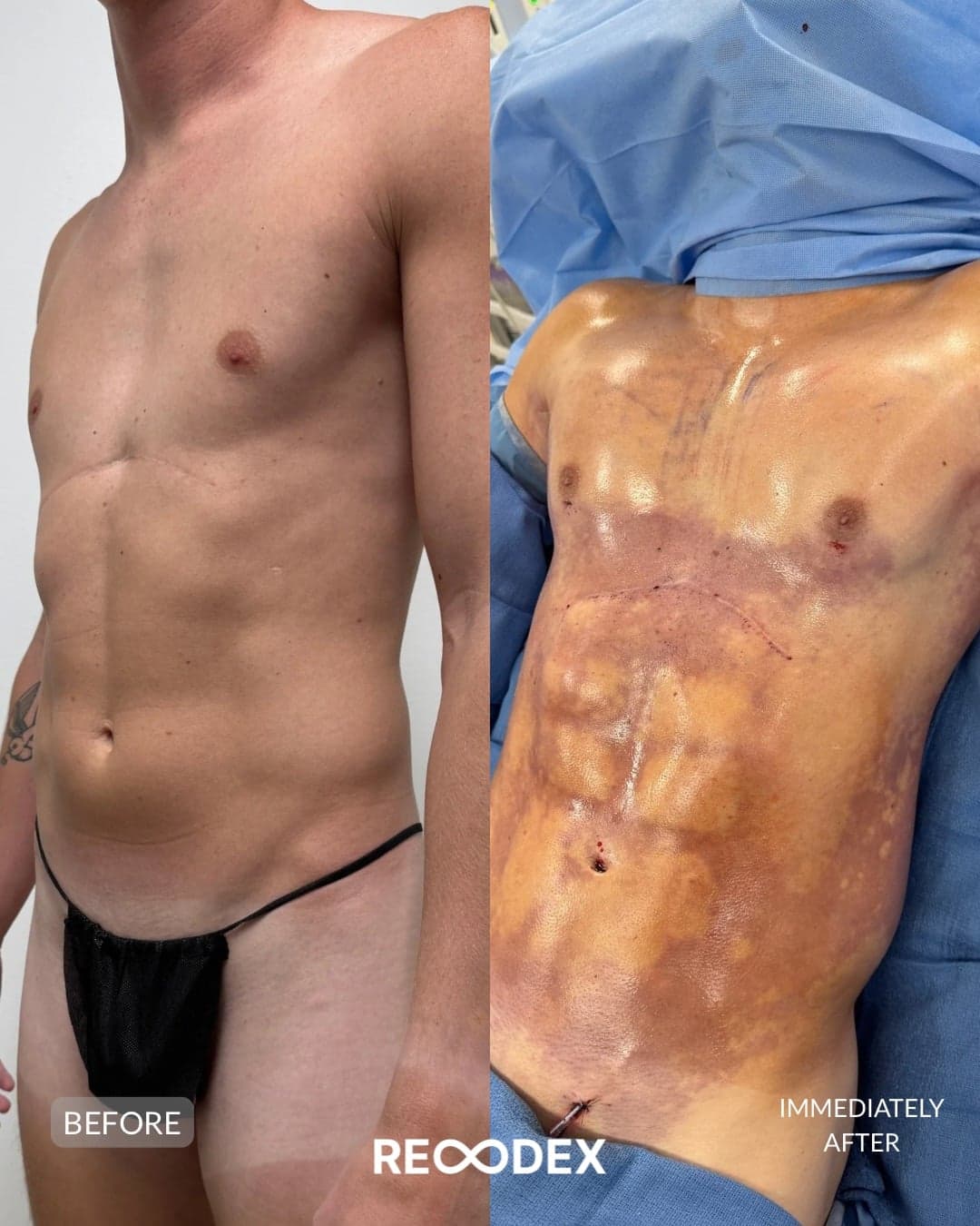 HD Body Sculpting & Implants — before and after