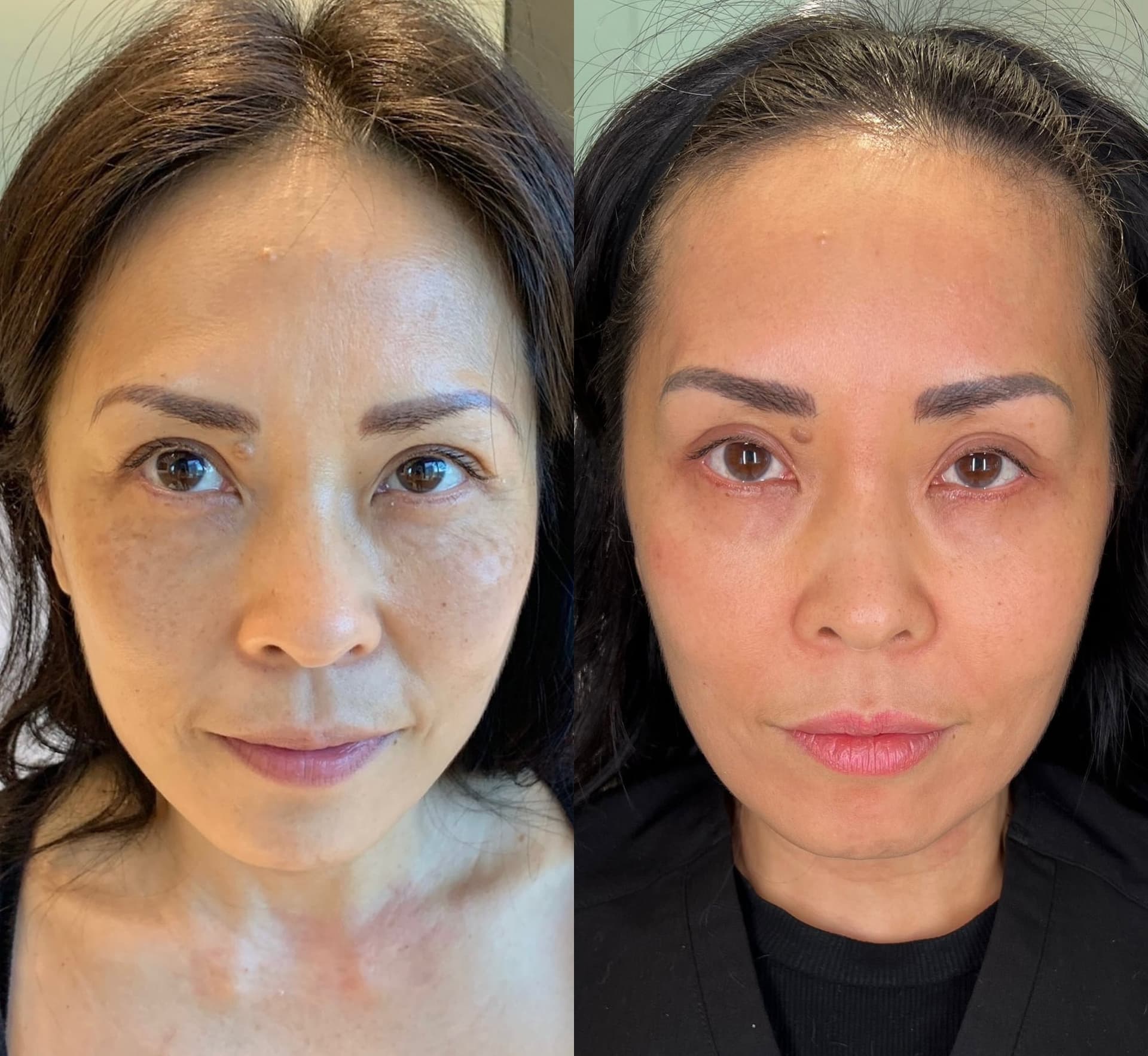 AETHRAFORM™ Reconstruction Before and After