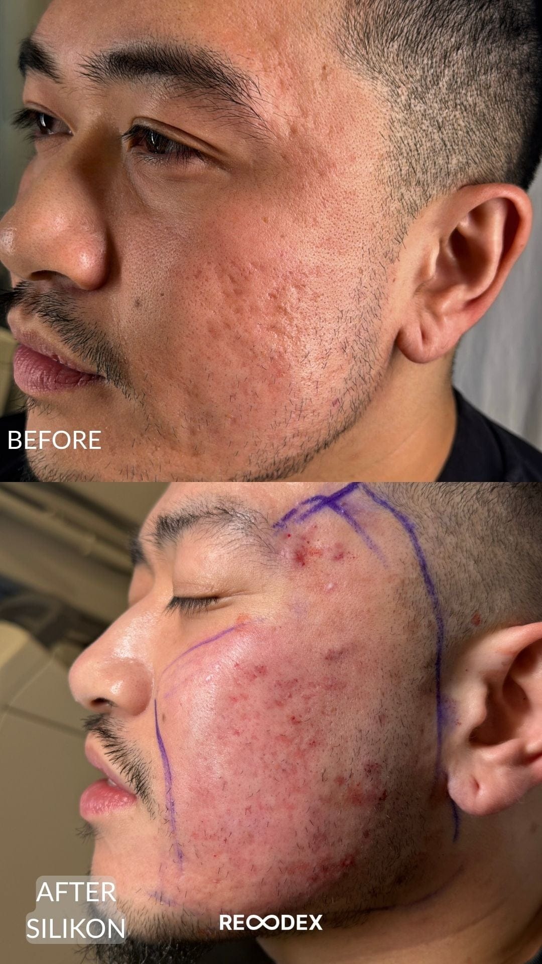 Acne Scar Treatment Before and After